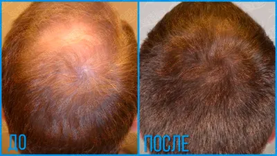 Мезотерапия для волос в Ульяновске, цена мезотерапии кожи головы, фото до и  после