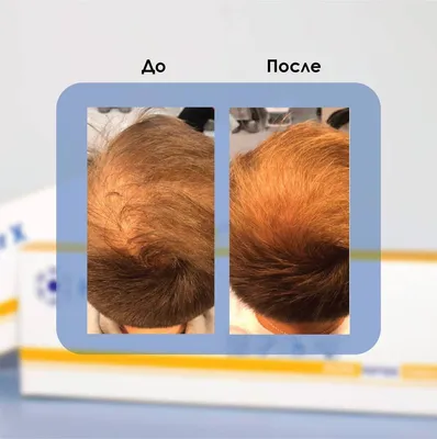 Мезотерапия кожи головы в Казани | Мезотерапия для волос в клинике  \"Совершенство\"