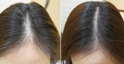 Мезотерапия головы от выпадения волос в клинике Биоми Вита