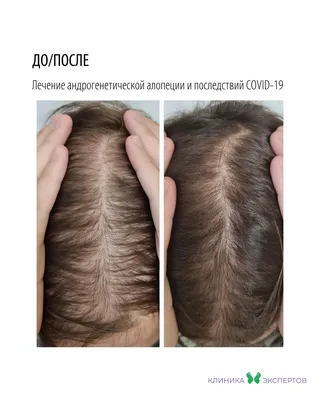 Мезотерапия при выпадении волос в Москве — 1759 трихологов, 80 отзывов,  цены и рейтинг на Профи
