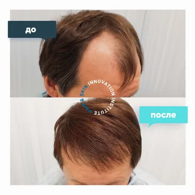 Лечение выпадения волос в Москве. Методы диагностики и лечения в Телос Бьюти