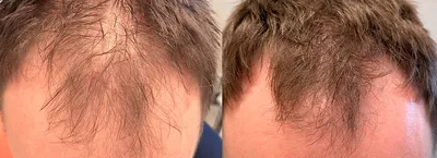 Фото до и после пересадки волос, фото пересадки волос