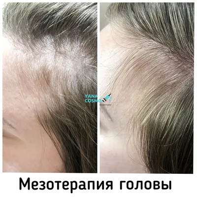 Мезотерапия кожи головы - цены на мезотерапию для волос от 1500 руб. в  Новосибирске