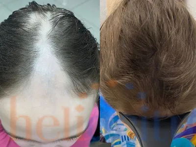 Мезотерапия для волос и кожи головы в «Азбуке Красоты»: цена на уколы