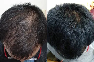 Мезотерапия для волос Калуга | Цена процедуры в клинике трихологии С-Тетик  - Косметологический центр