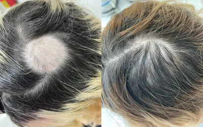 Мезотерапия волос в Киеве - Diamond Laser