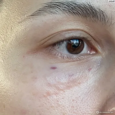 Мезотерапия для кожи вокруг глаз, для улучшения микроциркуляции. | Instagram