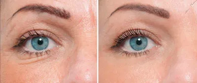 Мезотерапия глаз: эффективный метод омоложения кожи вокруг глаз