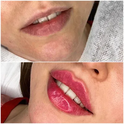 Фракционная мезотерапия губ💋... - viktoriya_cosmetologprof | Facebook