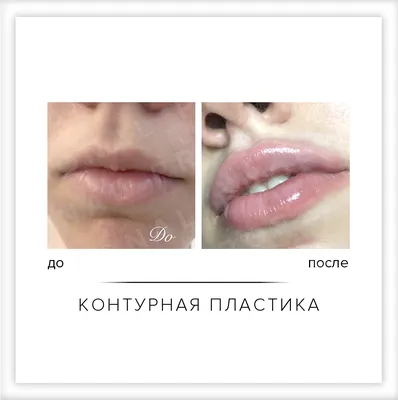 Увеличение губ гиалуроновой кислотой в Москве - клиника Век Адалин