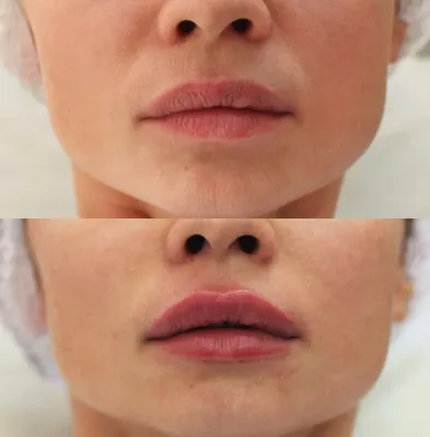 Увеличение губ — Пластическая хирургия Уфа