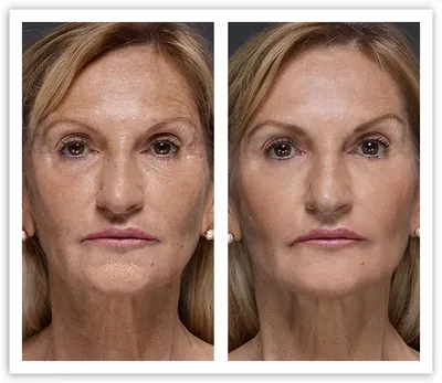 Фотографии до и после фотоомоложения кожи вокруг глаз, проводим в клинике  Premium Aesthetics