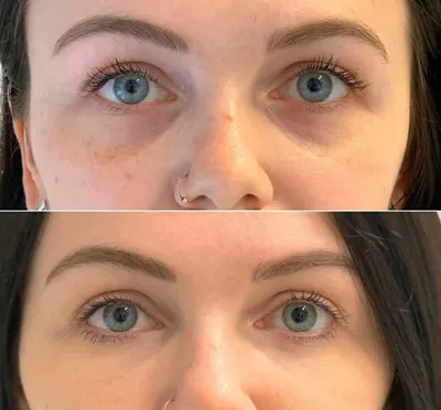 Биоревитализация кожи вокруг глаз: цена, отзывы, фото до и после