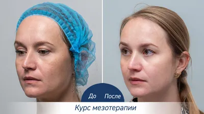 Простые правила по уходу за глазами после блефаропластики - Cosmetic-clinic