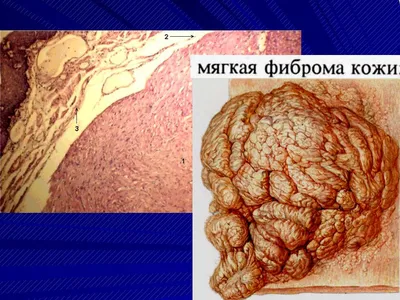 Фиброма кожи - симптомы, лечение, профилактика, причины, первые признаки -  болезни и состояния на Здоровье Mail.ru