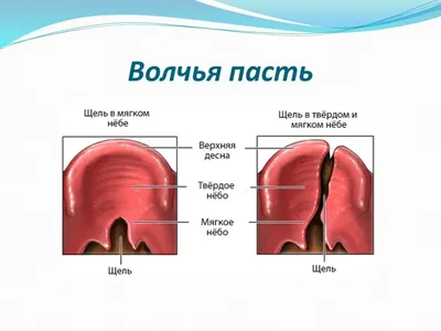 Мягкое небо; небная занавеска - e-Anatomy - IMAIOS