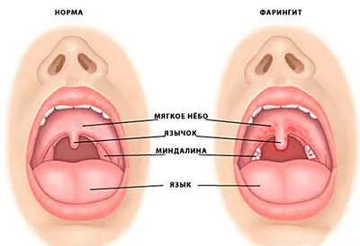 Паралич мягкого нёба - презентация онлайн