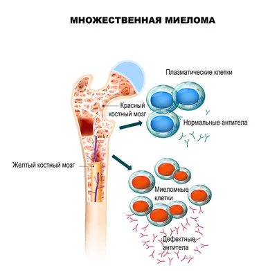 Миеломная болезнь - причины появления, симптомы заболевания, диагностика и  способы лечения