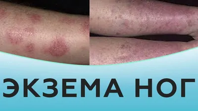 Лечение дерматита в Киеве — Derma.ua