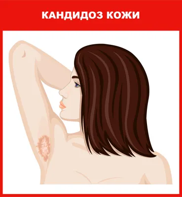 Лечение микоза кожи в Киеве. Лечение грибка кожи рук, ног и др. частей тела  в клинике Бреннера.