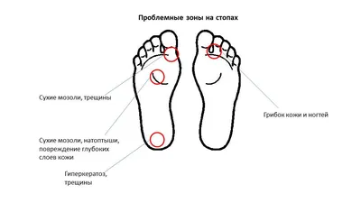 Грибок кожи, ногтей, складок | Центр подологии и остеопатии Татьяны Красюк