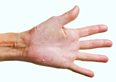 Anna Belokon - Онихомикоз (или грибок ногтей) на руках встречается  значительно реже, чем на ногах. Источником грибка могут стать онихомикоз на  стопах, заболевание родных и близких (в семье грибок передается через  пользование