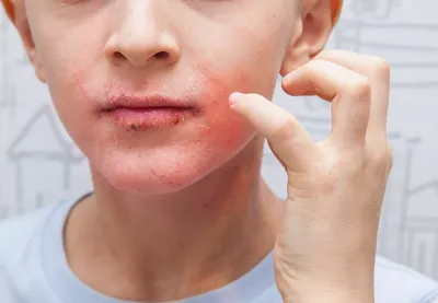 Экзема на лице: лечение народными средствами, фото, причины возникновения,  как она выглядит на коже у женщин