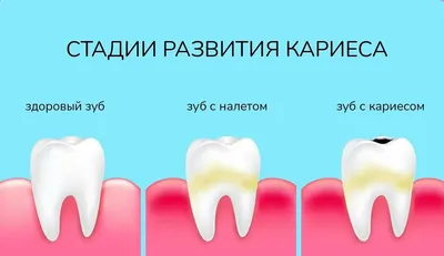 Кариес и пульпит молочных зубов: причины, симптомы, лечение - энциклопедия  Ochkov.net