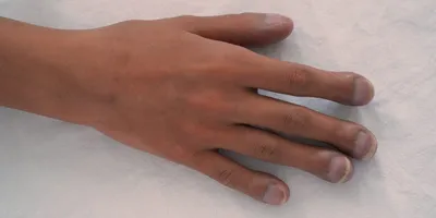 Эссенция для лечения грибка ногтей Jemeesen 7 дней, сыворотка для ухода за  кожей рук, уход за ногами, удаление, восстановление, удаление грибка ногтей,  гель против инфекции | AliExpress