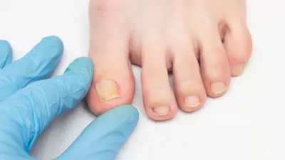 Диабет, псориаз или воспаление: на какие болезни может указывать состояние  ногтей - МЕТА