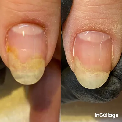 Средство для лечения грибка ногтей, сыворотка для ногтей, удаление Fungul  Paronychia Onychomycosis против инфекции, восстанавливающая эссенция для  ногтей | AliExpress