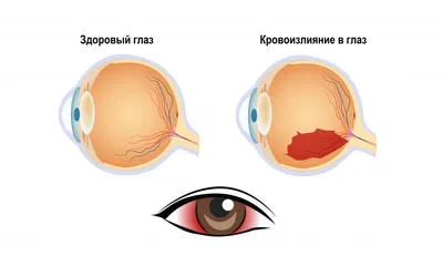 Инсульт глаза (окклюзия) - симптомы, лечение, причины, последствия | Наш  дом в Новороссийске | Дзен