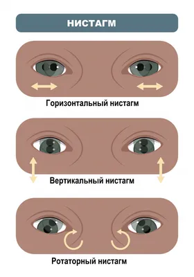 Микроинсульт: симптомы и последствия - Блог НаПоправку