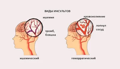 Инсульт глаза (окклюзия) - симптомы, лечение, причины, последствия | Наш  дом в Новороссийске | Дзен