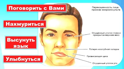 Микроинсульт, самый простой вариант чтобы не разбираться в проблеме.  #инсульт | Instagram