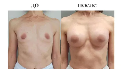 Dr. Levon Babayan - Маммопластика (изменение формы и размера груди).  Операция помогает увеличить, уменьшить или изменить форму молочных желез.  Медицинскими показателями для пластической операции груди являются:  микромастия (очень маленькая грудь ...