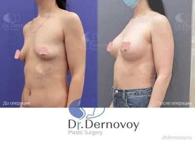 Увеличение груди (маммопластика) имплантами в Тольятти. Операция по  увеличению молочных желез - стоимость, фото