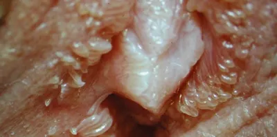 Микропапилломатоз половых губ, вульвы у женщин: причины и лечение, фото