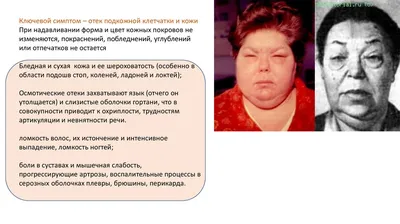 Cutaneous manifestations of endocrine diseases in children - Gorlanov -  Pediatrician (St. Petersburg)