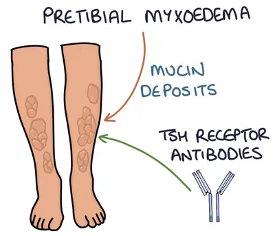 Image: Претибиальная микседема у пациента с болезнью Грейвса - Справочник  MSD Профессиональная версия