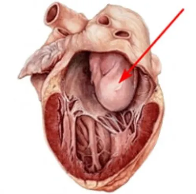 Миксома сердца — доброкачественная опухоль, локализующаяся в левом или  правом предсердии. | Instagram