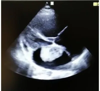 Павлодарский Кардиоцентр on Instagram: \"Миксома - доброкачественная опухоль  сердца.❤️ ⠀ Может располагаться в любой камере сердца. Но в 86%  располагается в левом предсердии. Обычно растёт на ножке прикреплённой к  перегородке. ⠀ Миксомы -