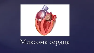 Павлодарский Кардиоцентр on Instagram: \"Миксома - доброкачественная опухоль  сердца.❤️ ⠀ Может располагаться в любой камере сердца. Но в 86%  располагается в левом предсердии. Обычно растёт на ножке прикреплённой к  перегородке. ⠀ Миксомы -