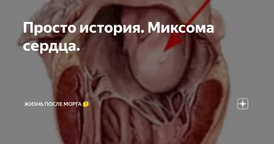 Каким бывает рак сердца — смертельная болезнь, о которой почти никто не  говорит - Hi-News.ru