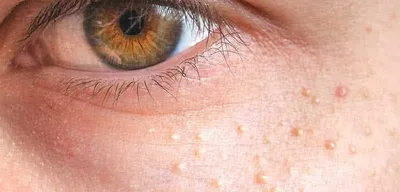 Милиумы на лице: особенности, отличия от просянки и белых точек под глазами