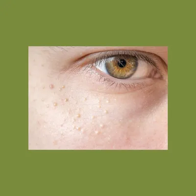 Dr. NY Cosmetology - Удаление милиумов ⠀ ☝🏻Милиумы (белые угри,  «просянки», ретенционные кисты) – это мелкие выпуклые образования диаметром  1–2 мм, которые появляются под верхним слоем кожи. ⠀ ☝🏻Внешне милиумы  выглядят как