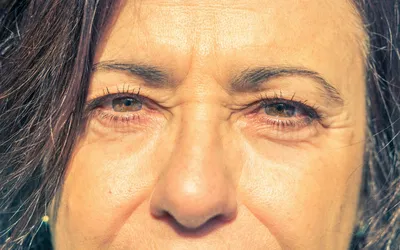 Коррекция морщин вокруг глаз | Цена | Age Clinic Москва