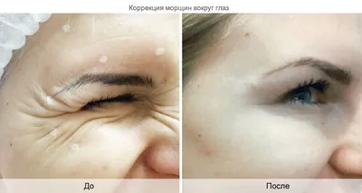 Удаление мимических морщин вокруг глаз в клинике косметологии «Градиент» в  Москве