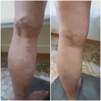 Фото до и после лечения расширенных вен, эндовенозная лазерная коагуляция и  минифлебэктомия – Петр Александрович Пироженко