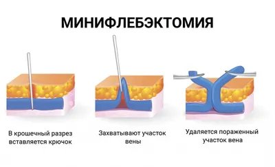 Флебэктомия в Москве - цены в Damas Medical Center